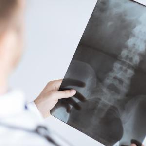 Fruits, cereals, fish help protect against lumbar spinal stenosis