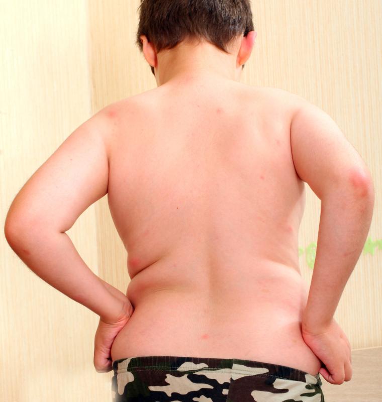 BMI mediates link between serum Mg level, insulin resistance in children