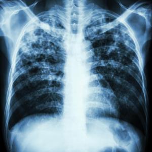 Nocturnal hypoxaemia tied to adverse outcomes in interstitial lung disease