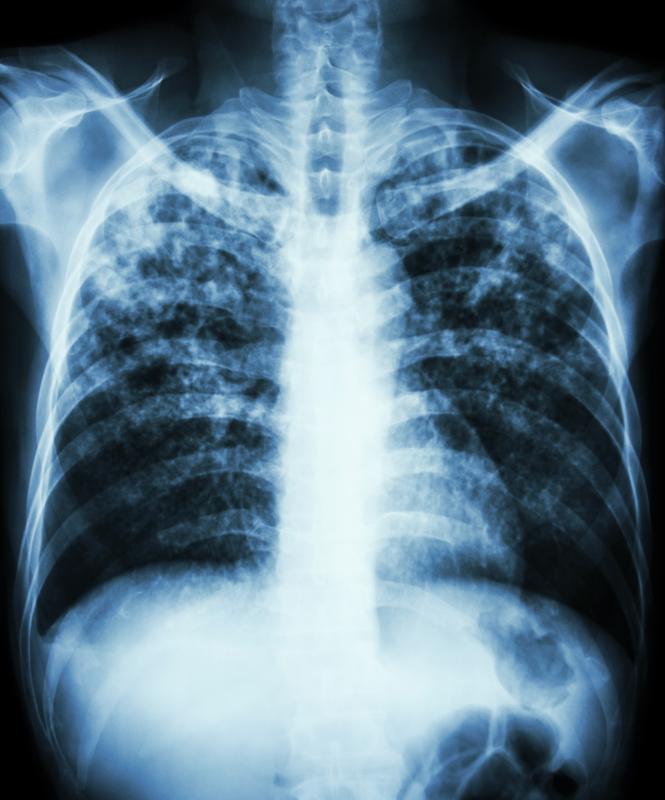 Nocturnal hypoxaemia tied to adverse outcomes in interstitial lung disease