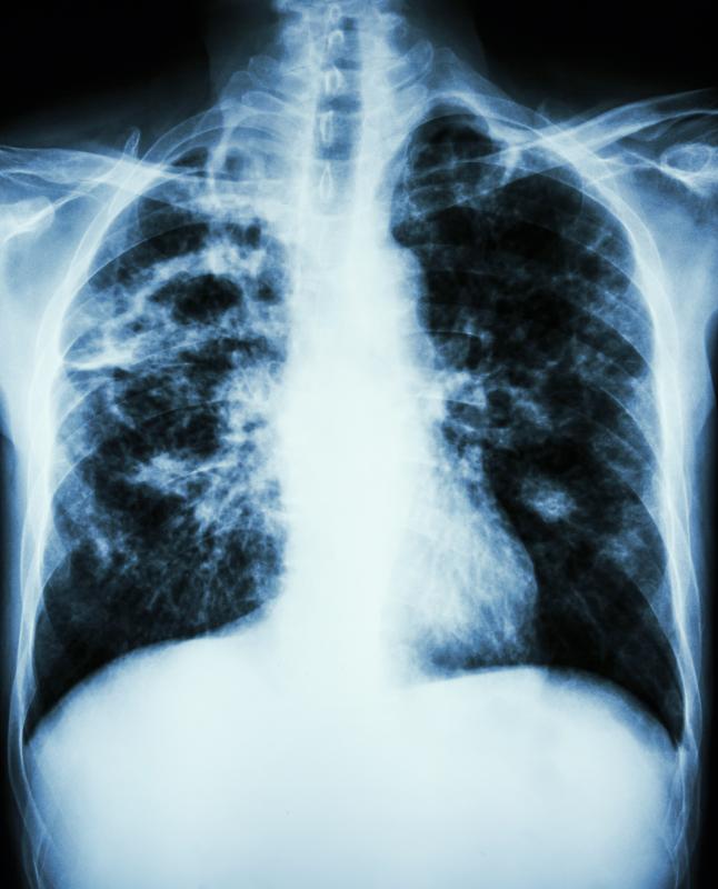 MiRNA‐4508 a potential diagnostic biomarker for silica‐related pulmonary fibrosis