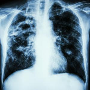 S100A4 predicts mortality in idiopathic pulmonary fibrosis