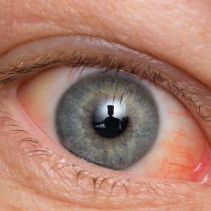 Long-term hormone therapy may increase cataract risk in women with T2D