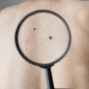 Multiple moles, genetic predisposition up risk of second primary melanomas