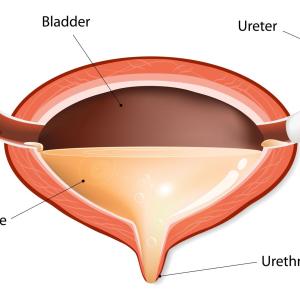 Perineal urethrostomy helps improve outcomes in complex urethral strictures