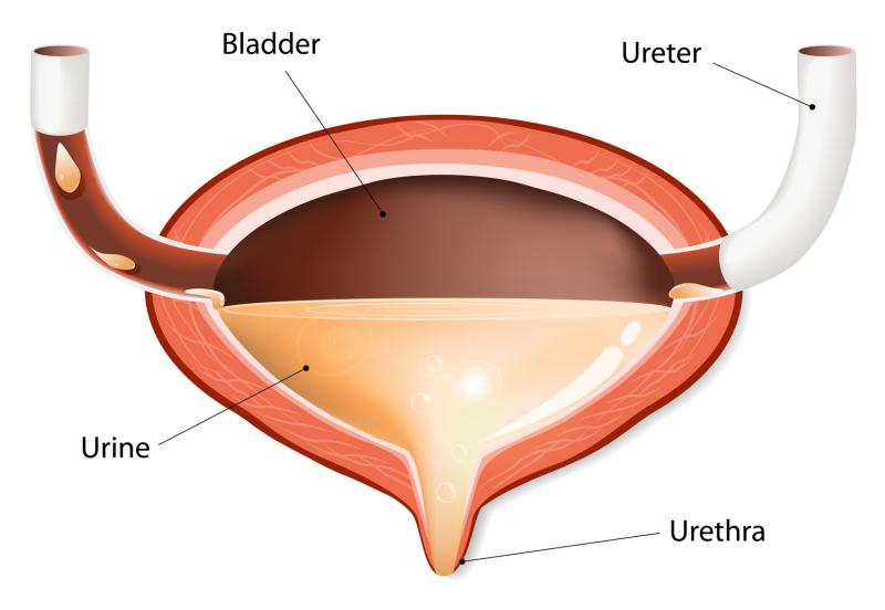 Perineal urethrostomy helps improve outcomes in complex urethral strictures