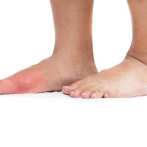 Serum urate-related genetic variants contribute to gout risk in people on diuretics