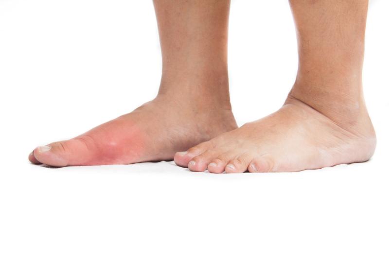 Information, treatment understated in images for educational resources about gout