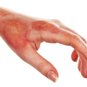 Smoking, discoid lesions prevent long-term remission in cutaneous lupus erythematosus