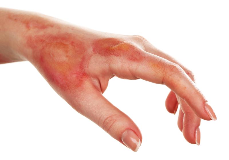 Smoking, discoid lesions prevent long-term remission in cutaneous lupus erythematosus