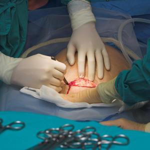Antimicrobial stewardship helps reduce postelective caesarean antibiotic use