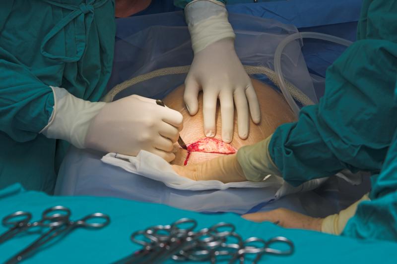 Antimicrobial stewardship helps reduce postelective caesarean antibiotic use