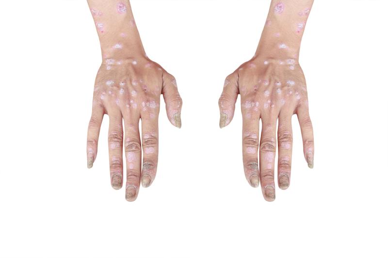 Lenabasum effective, well tolerated in refractory dermatomyositis