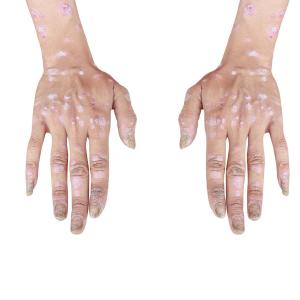 Microneedle technology on par with topical steroids in nail psoriasis treatment