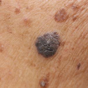 RCM enables less invasive diagnosis in derma patients
