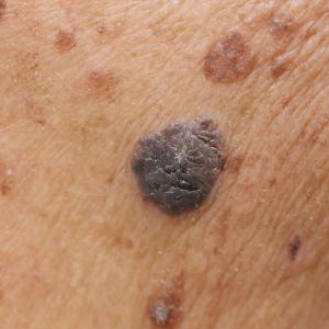 Serum vitamin D lower in melanoma patients