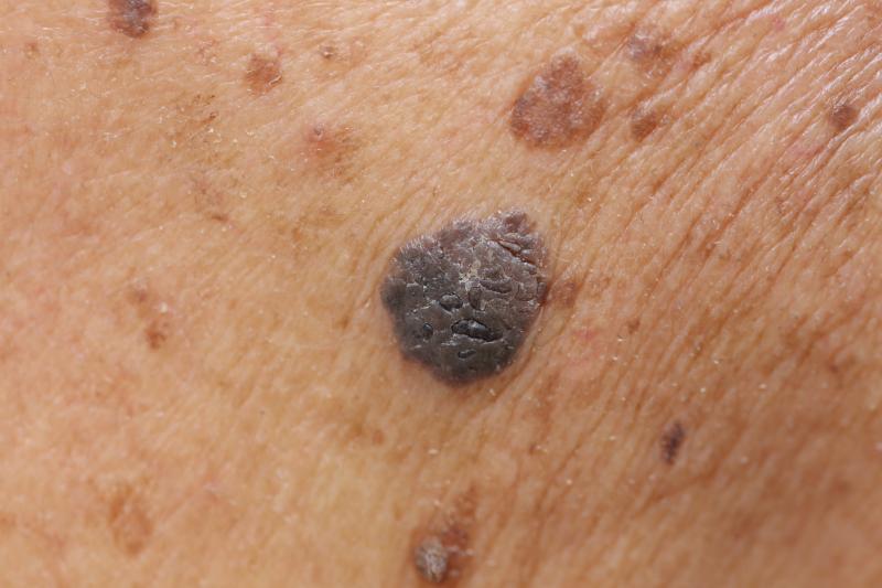 Serum vitamin D lower in melanoma patients