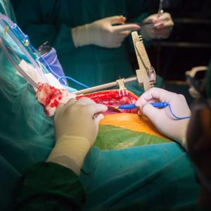 Aspirin plus ticagrelor/clopidogrel prevents saphenous vein graft failure after CABG surgery