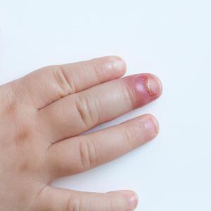 Nailfold abnormality ups calcinosis risk in juvenile dermatomyositis