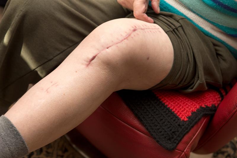 Autologous fat transfer promising for scar conditions, fibrosis