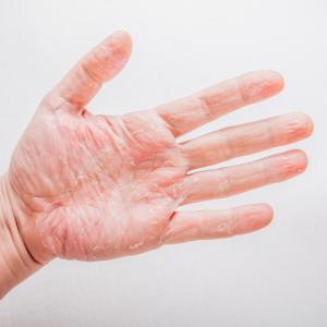 Cancer patients on VEGFR-TKIs prone to hand-foot skin reaction