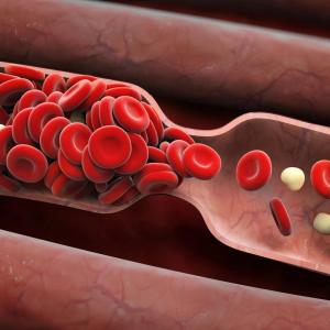 High serum phosphorus ups risk of coronary atherosclerosis in asymptomatic individuals