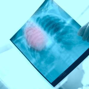 Virtual palliative care confers quality of life improvements in advanced NSCLC