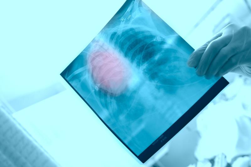 Virtual palliative care confers quality of life improvements in advanced NSCLC