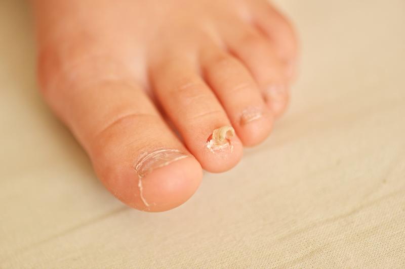 Laser plus mechanical abrasion for nail fungus falls flat