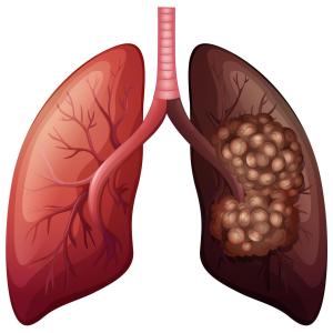 Cetuximab plus afatinib combo of no benefit in advanced EGFR-mutant NSCLC