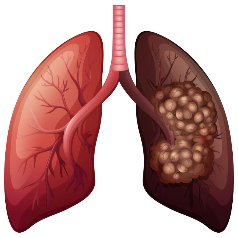 Cetuximab plus afatinib combo of no benefit in advanced EGFR-mutant NSCLC