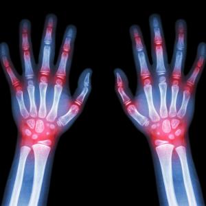 TLR4 blockade in rheumatoid arthritis disappoints in phase II trial