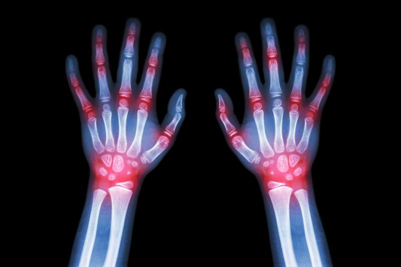 TLR4 blockade in rheumatoid arthritis disappoints in phase II trial