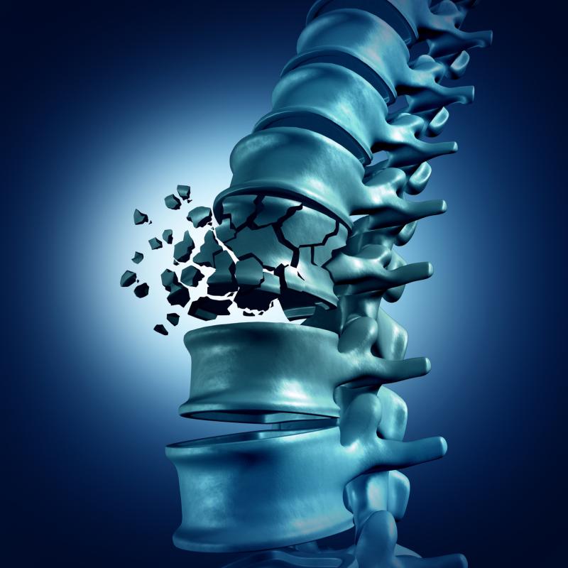 Living kidney donors predisposed to vertebral fractures