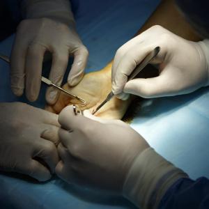 Transverse vs longitudinal: Which volar wrist incision is more preferred?