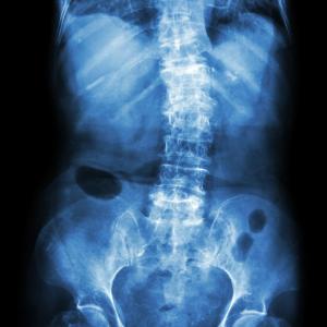 Homocysteine tied to spinal osteoarthritis prevalence in postmenopausal women