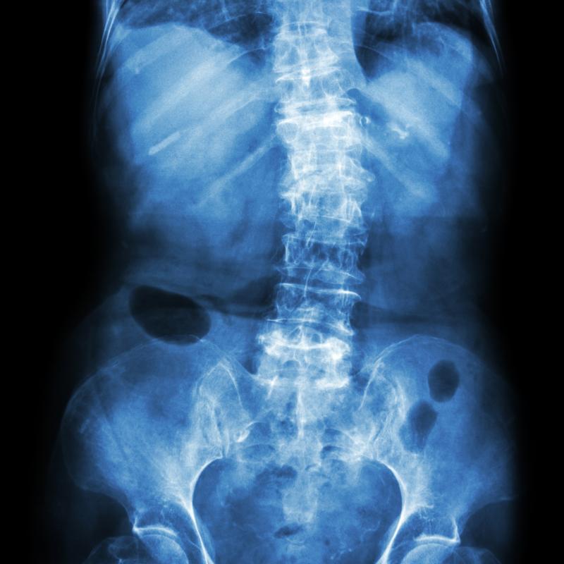 TNFi halts radiographic sacroiliitis progression in axial spondyloarthritis