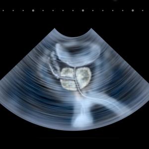 Water vapour thermal therapy relieves symptoms due to benign prostatic hyperplasia