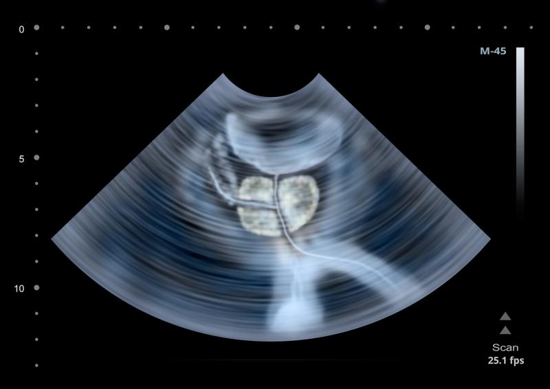 Antimicrobial prophylaxis does not prevent UTI after transurethral resection of bladder tumour