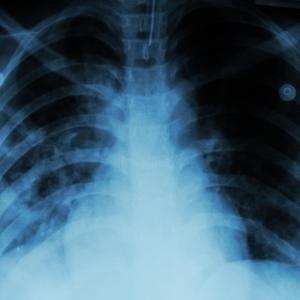 Obesity, sleep apnoea do not contribute to increased sarcoidosis risk