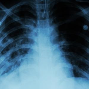 Chinese men with pleural tuberculosis at greater risk of empyema