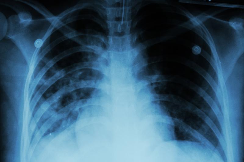 Chinese men with pleural tuberculosis at greater risk of empyema