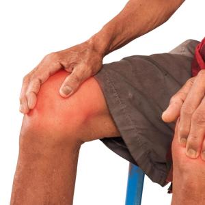 People with psoriatic arthritis at greater risk of developing osteoarthritis