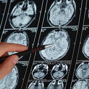 Veterans with higher traumatic brain injury predisposed to subsequent brain cancer