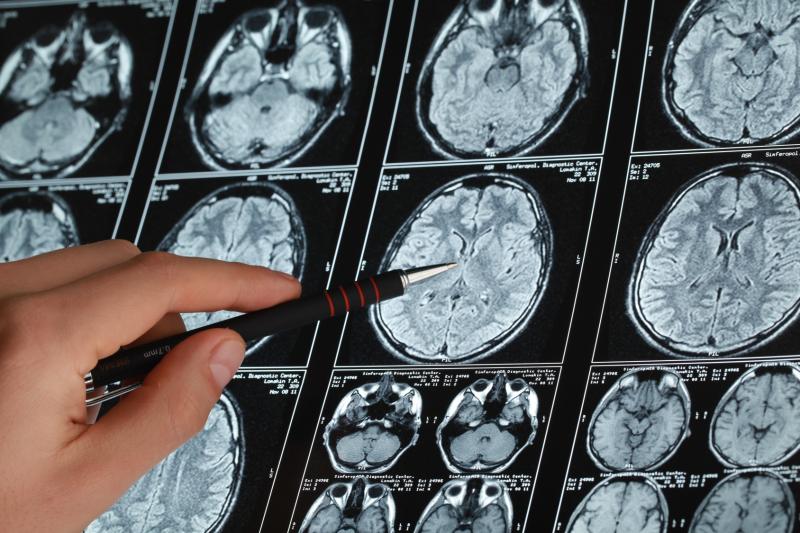 Novel tool predicts survival in brain metastasis patients