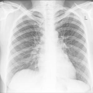 Investigational DP2 antagonist strikes out in eosinophilic asthma