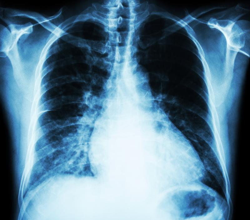 What radiographic features are common in COVID-19 patients?