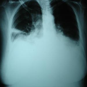 Unilateral pleural effusion mars diaphragmatic function, causes hyperactivity