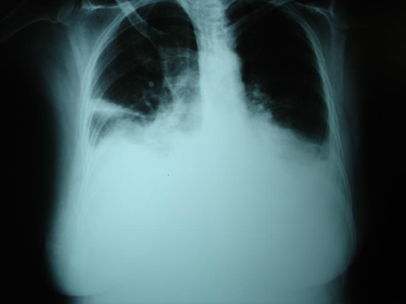 Unilateral pleural effusion mars diaphragmatic function, causes hyperactivity