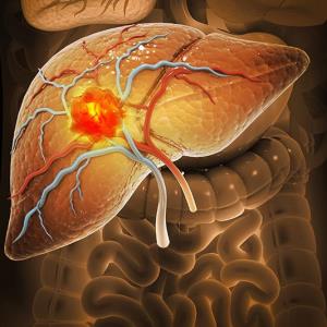 Frontline nivolumab plus ipilimumab ups OS, ORR in patients with uHCC